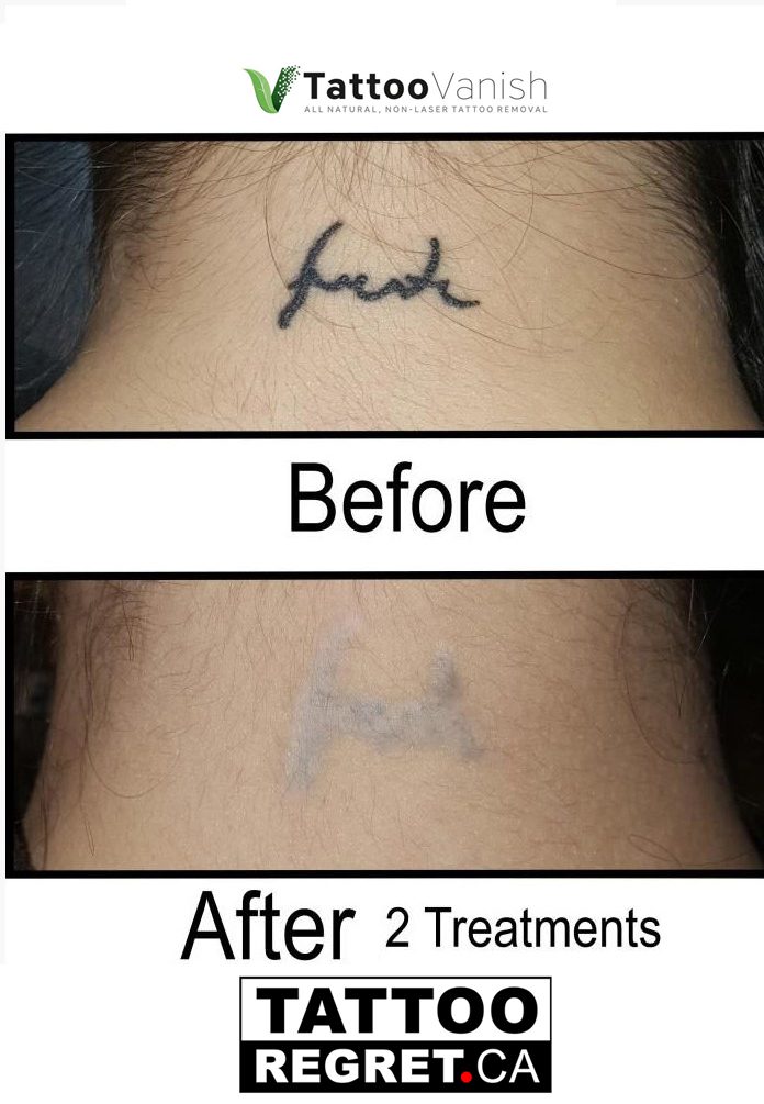 Tattoo Removal Before and After Markham