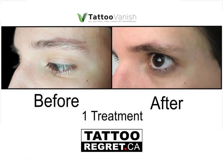 Tattoo Removal Before and After Mississauga
