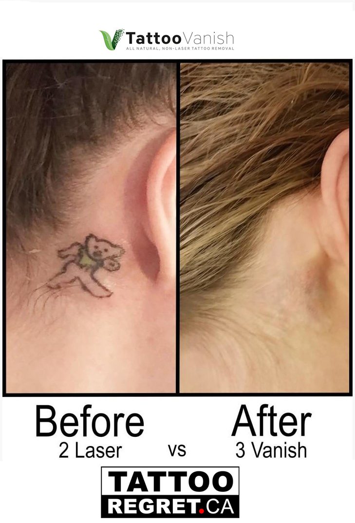 Tattoo Removal Before and After Ontario