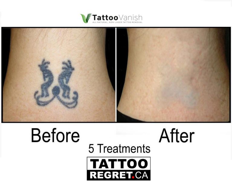 Tattoo Removal Before and After Richmond Hill