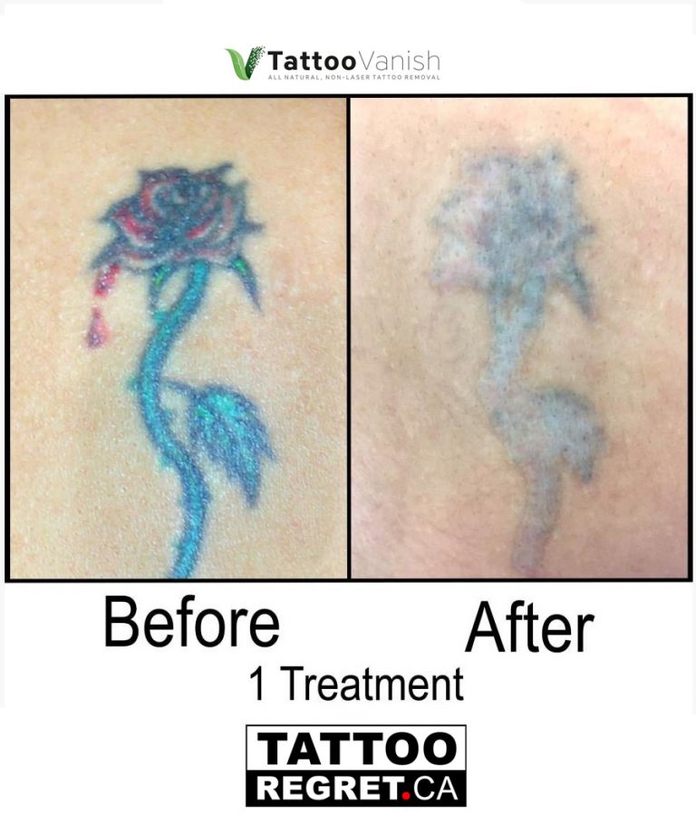 Tattoo Removal Before and After Richmond Hill ON