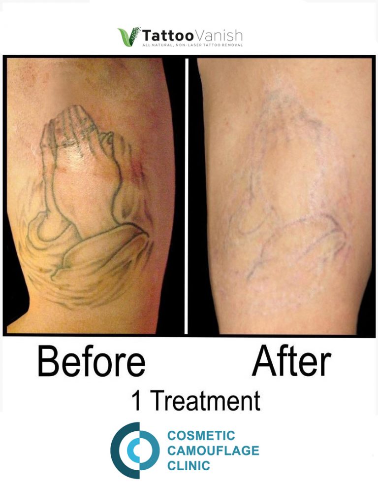 Tattoo Removal Before and After Toronto