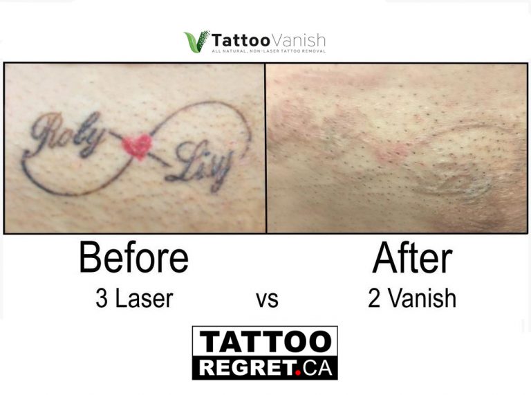 Tattoo Removal Before and After Toronto Ontario