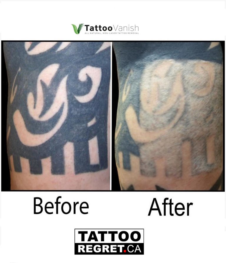 Tattoo Removal Brampton