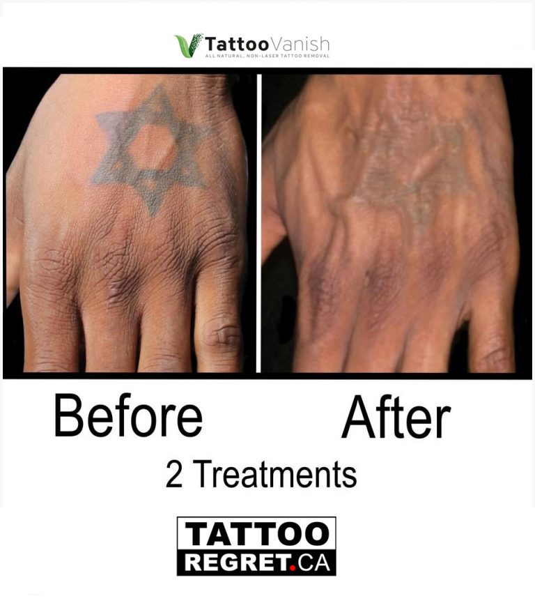 Tattoo Removal before after Toronto ON