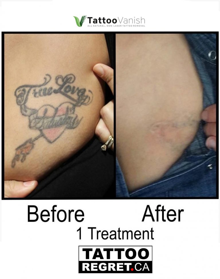 Tattoo Removal before after Toronto Ontario