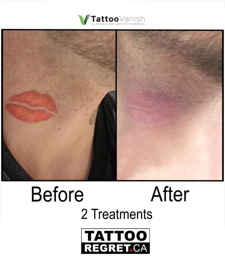 Tattoo removal aftercare
