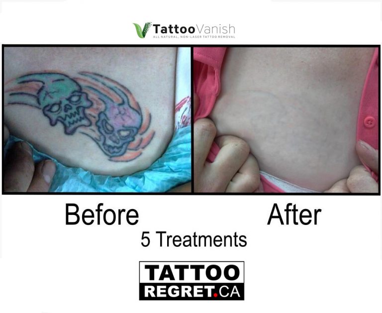 Tattoo removal before after Toronto
