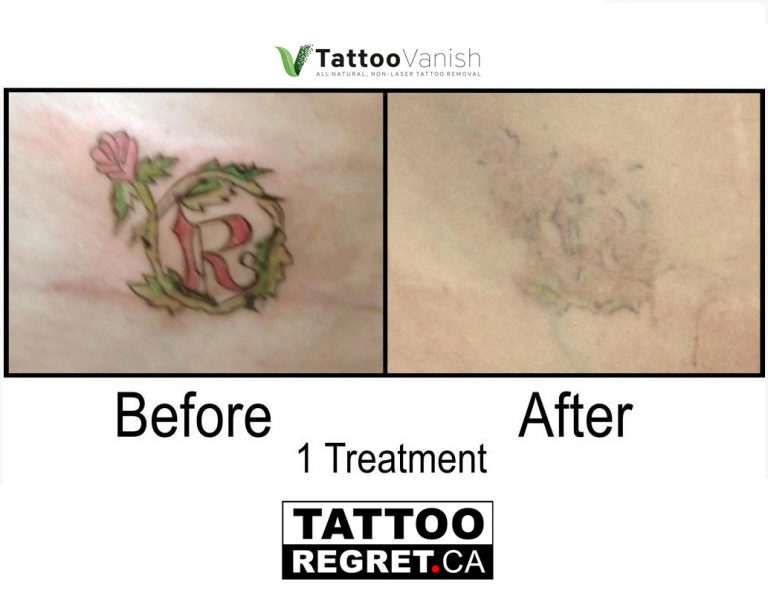 Tattoo removal cream Canada
