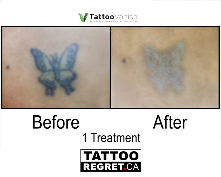 how to remove tattoo