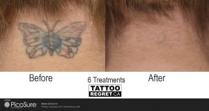 laser tattoo removal before and after Toronto (1)