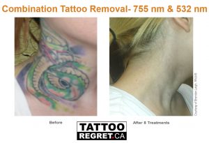 laser tattoo removal before and after Toronto