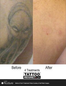 laser tattoo removal before and after Toronto (1)