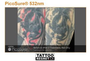 laser tattoo removal before and after Toronto (1)