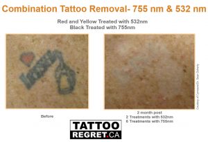 laser tattoo removal before and after Toronto (1)