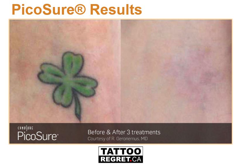 Before and after results from 5 laser tattoo removal treatments on wrist!  Tattoo almost gone! #tattooremovalbeforeandafter