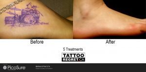 laser tattoo removal before and after Toronto (1)