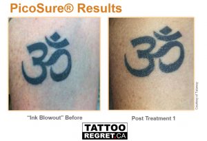 laser tattoo removal before and after Toronto (1)