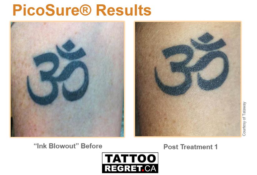 View Tattoo Removal Before and After Images