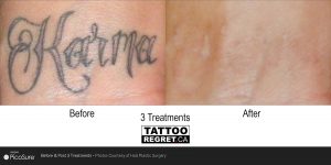 laser tattoo removal before and after Toronto (1)