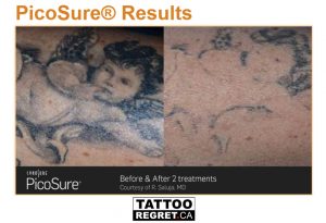 laser tattoo removal before and after Toronto (1)