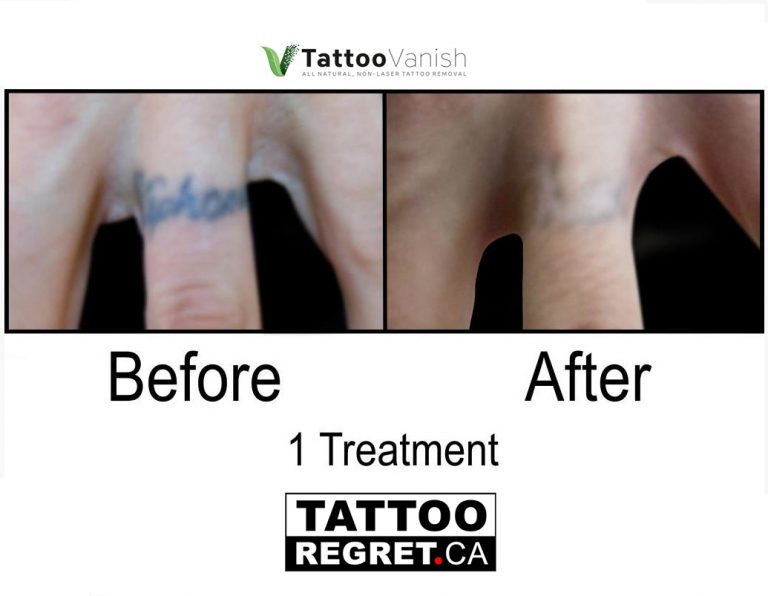 saline tattoo removal