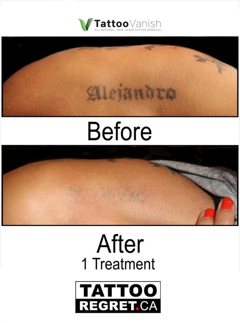 tattoo removal results