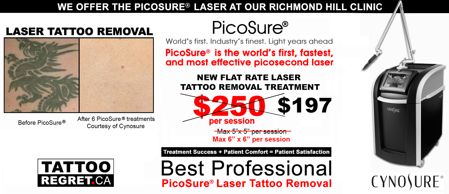 Tattoo Removal Toronto - Laser Tattoo Removal Before and After - Tattoo Removal Cost