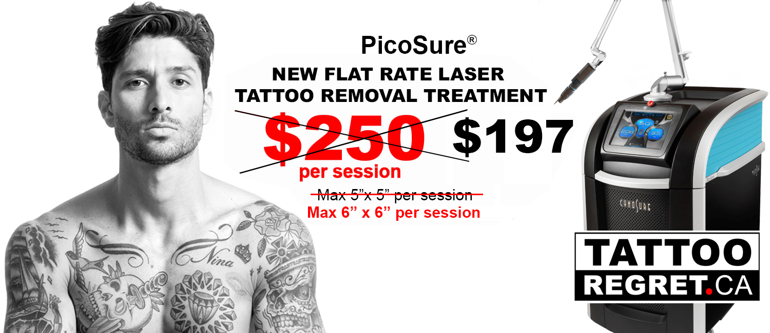 tattoo laser removal - tattoo removal Toronto - Laser tattoo removal Removal before and after