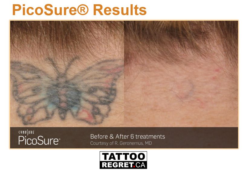 how to remove temporary tattoos
