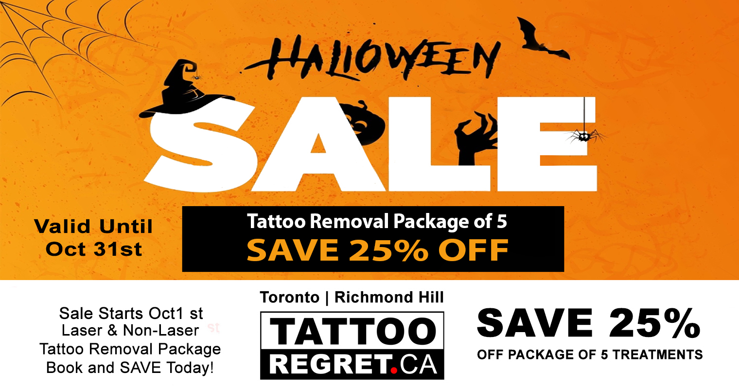 laser tattoo removal Toronto