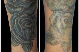 Before and After Tattoo Removal - Get the Best Res (14)