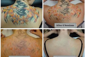 laser tattoo removal-REVISED_html_7e4b6a80789dd036