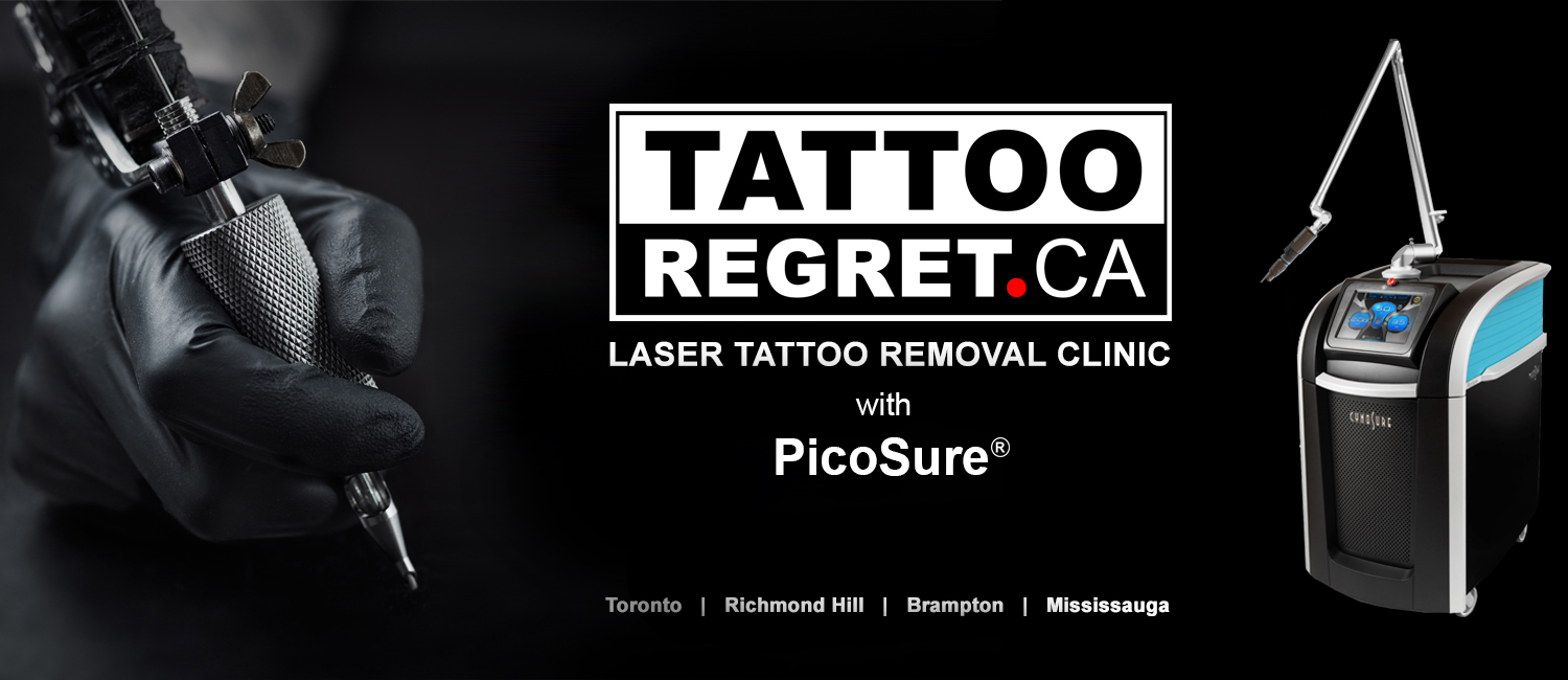 Tattoo removal Before and After